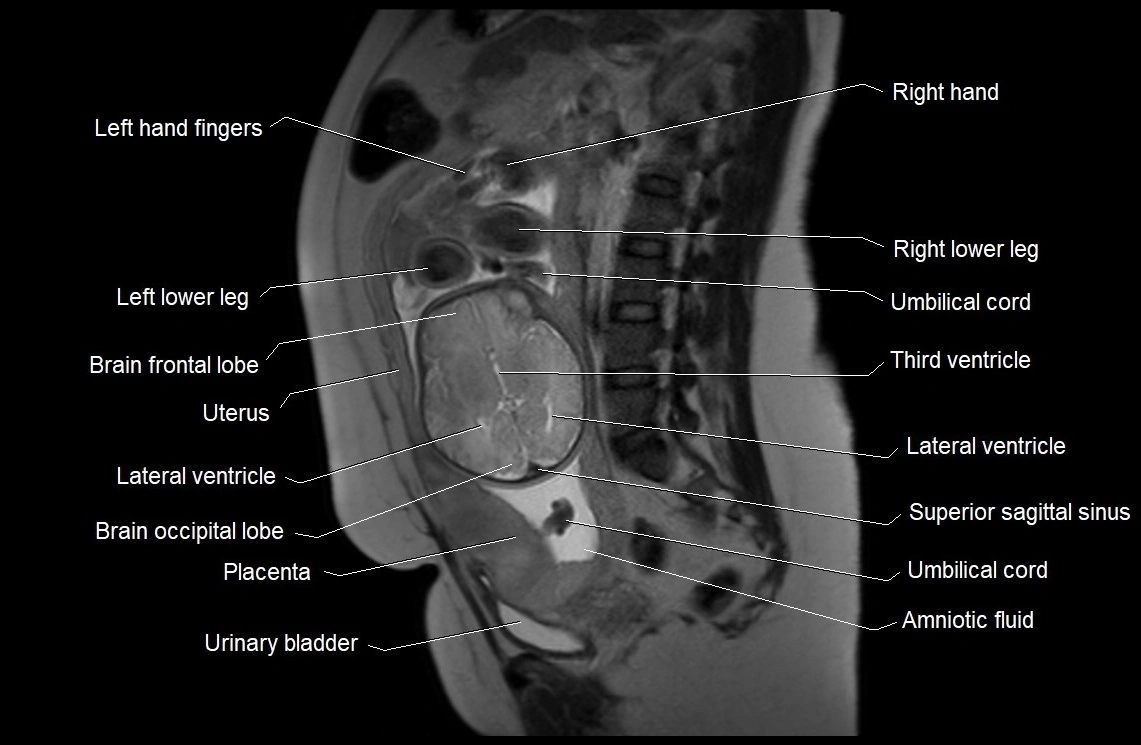 MRI fetal anatomy sagittal image 21.webp